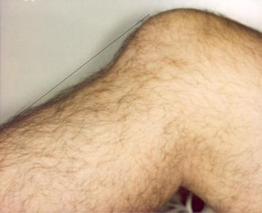 Close-up view of a posterior tibia sag with an inc