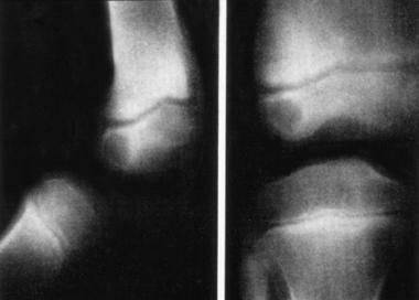 Anteroposterior and lateral radiographs of the dis