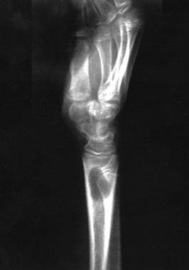 Lateral radiograph of the distal radius. This imag