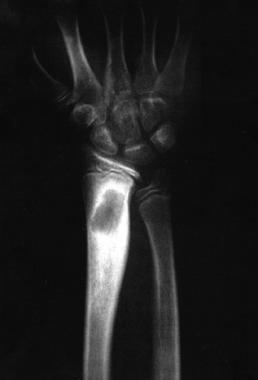 Anteroposterior radiograph of the distal radius. T