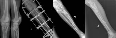 Type VI tibial plateau fracture with severe soft t