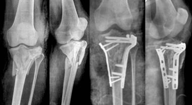 High-energy type VI tibial plateau fracture treate