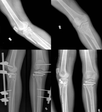 Type II tibial condyle fracture involving the tibi