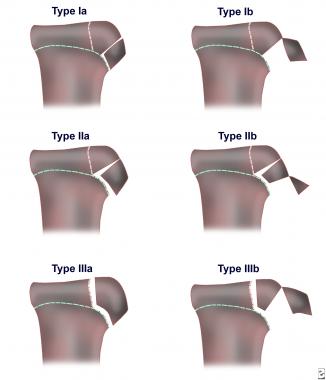 Classification of tibial tuberosity fractures. 