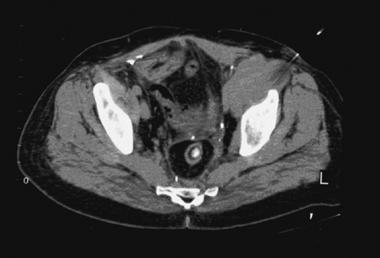 CT-guided needle biopsy of high-grade soft tissue 