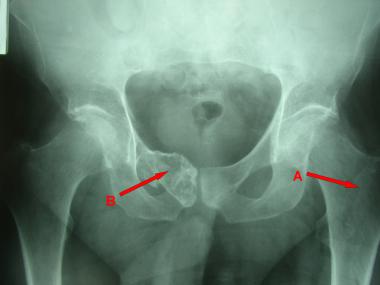 Plain radiograph shows low-grade chondrosarcoma in