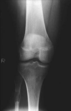 Plain radiograph demonstrating multiple fibrous co