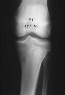 Plain radiograph of fibrous cortical defect of the