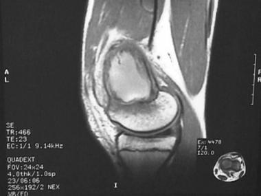 Magnetic resonance image (MRI) of low-grade centra