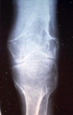 Radiograph of a patient with Gorham disease showin