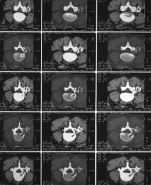 (Click image to enlarge.) Osteoblastoma with a sec