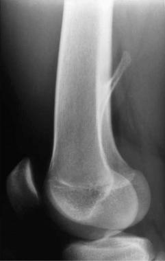 Solitary osteochondroma. Lateral radiograph of a p