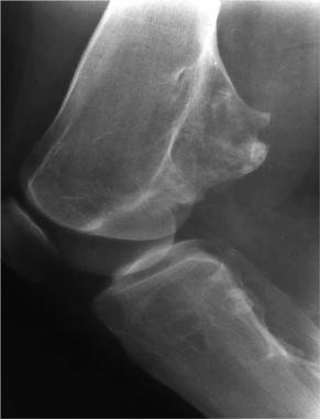 Solitary osteochondroma. Lateral radiograph of a s