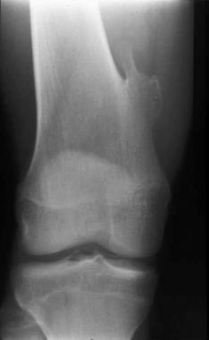 Solitary osteochondroma. Anteroposterior radiograp