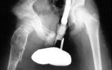 Large unicameral bone cyst of pelvis. Pathologic f