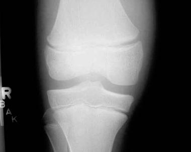 Growth plate (physeal) fractures. Anteroposterior 