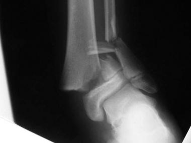 Growth plate (physeal) fractures. Clinical appeara