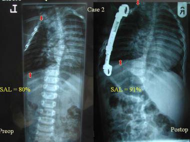 Preoperative and postoperative radiographs show an