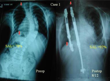 Preoperative and postoperative radiographs show an