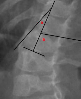 RVAD (rib-vertebral angle difference) measurement 