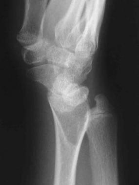 Preoperative lateral radiograph of wrist of patien