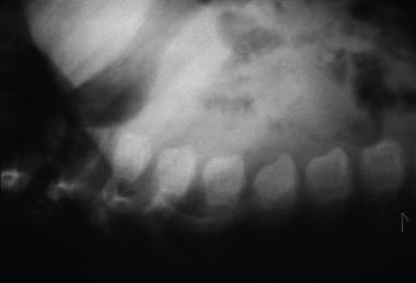 Morquio syndrome; lateral radiograph of thoracolum