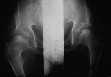 Hurler syndrome; widened metaphyses and diaphyses 