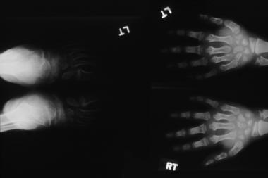 Hurler syndrome; widened metaphyses and diaphyses 