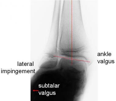 Lateral impingement may be due to ankle valgus, hi