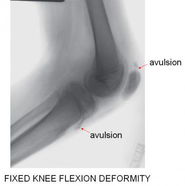 The lateral radiograph best demonstrates the open 