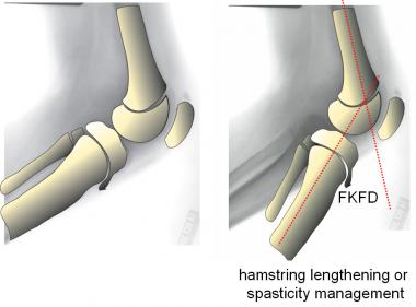 For flexion contracture, spasticity management (Bo