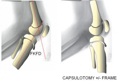 A posterior capsulotomy with or without PCL releas