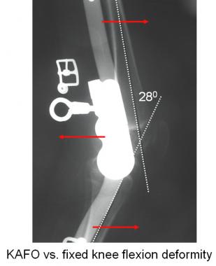 Locking KAFO may support the patient for standing 