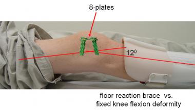 The efficacy of floor reaction braces is compromis