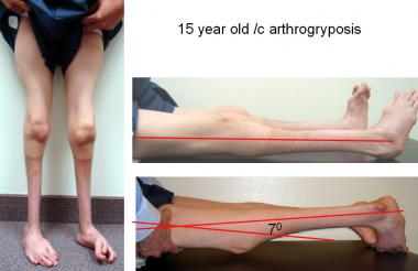 This ambulatory 15-year-old boy with arthrogryposi