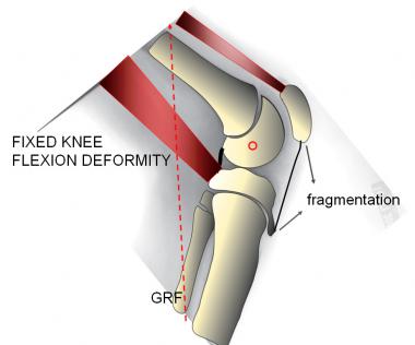 Fixed knee flexion deformity (FKFD). The knee is c