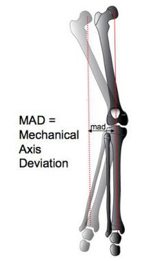 This diagram depicts genu valgum involving the rig