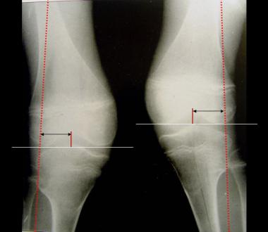 This 9-year-old patient has symmetrical and progre