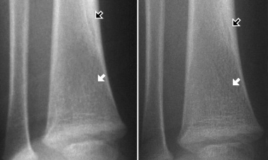 Toddler's fracture. Reproduced with permission fro