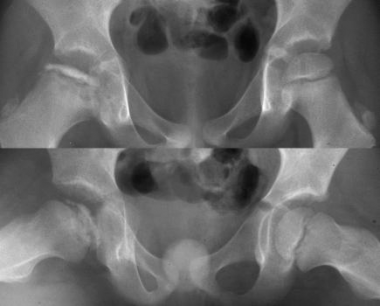 Legg-Calve-Perthes disease. Patient with a painful