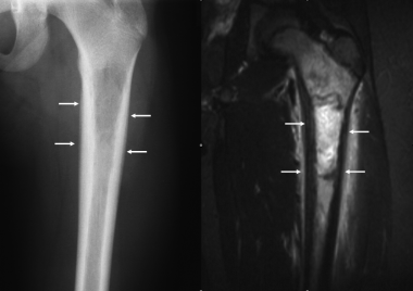 Ewing sarcoma. Anteroposterior radiograph of the f