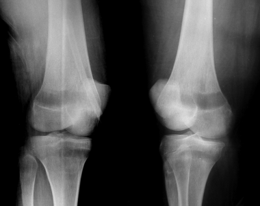 Knee radiographs in leukemia. Oblique radiographs 