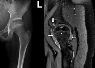 Juvenile idiopathic arthritis. Anteroposterior rad