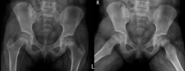 Slipped capital femoral epiphysis. Anteroposterior