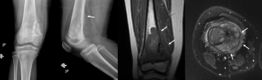 Osteosarcoma. Anteroposterior and lateral radiogra