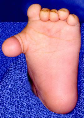 Preoperative photograph of a 1-year-old child with