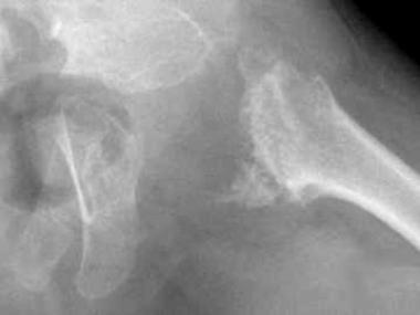 Spondyloepiphyseal dysplasia. Radiograph of the pe