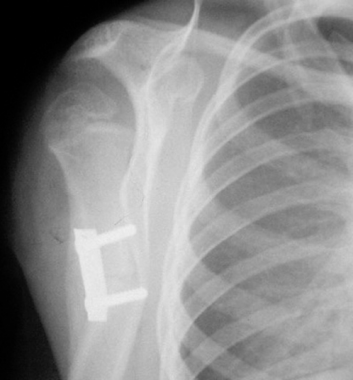 Postoperative anteroposterior radiograph showing h