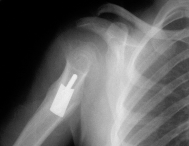 Postoperative lateral radiograph. 