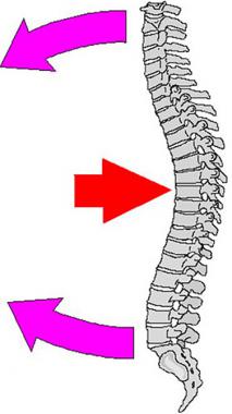 Chance fracture or modified compression fracture o